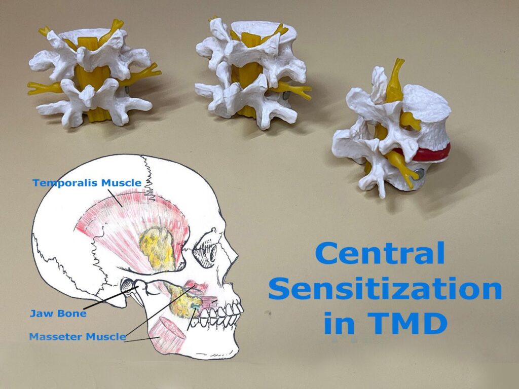 Pain Management for Central Sensitization in Temporomandibular Disorders